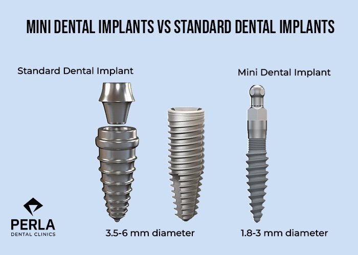 Mini Dental Implants: Benefits, Procedure, Cost and Recovery Mini Dental Implants vs Standard Dental Implants