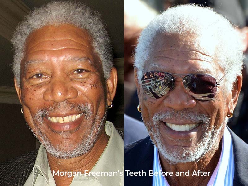 Morgan Freeman Teeth Before and After