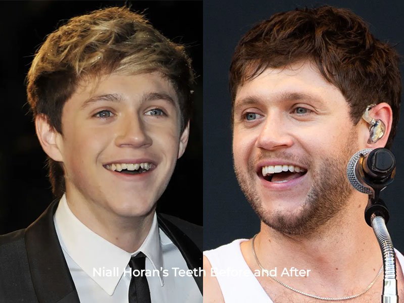 Niall Horan Teeth Before and After