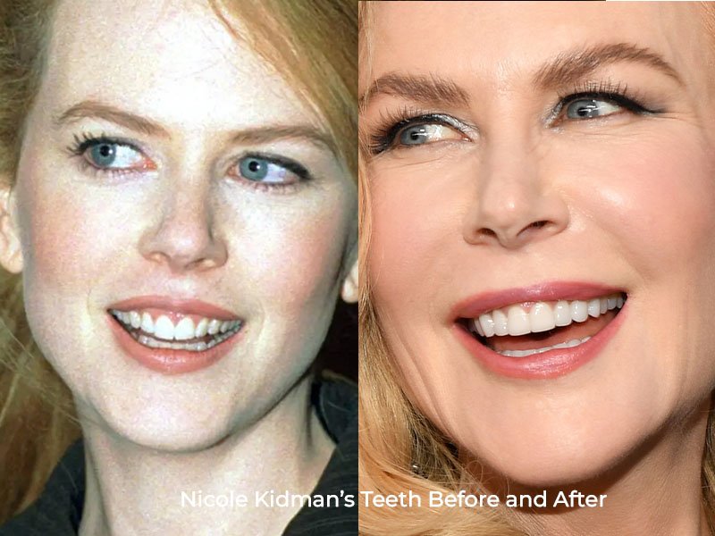 Nicole Kidman Teeth Before and After