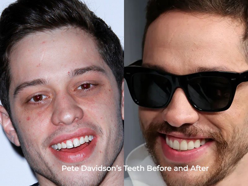 Pete Davidson Teeth Before and After