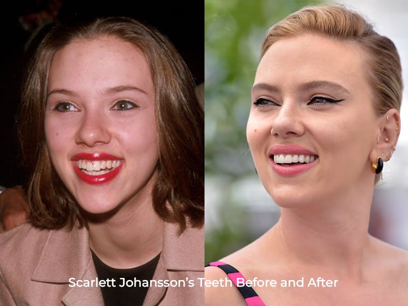 Scarlett Johansson Teeth Before and After