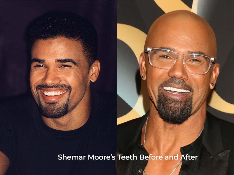 Shemar Moore Teeth Before and After
