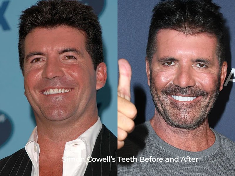 Simon Cowell Teeth Before and After