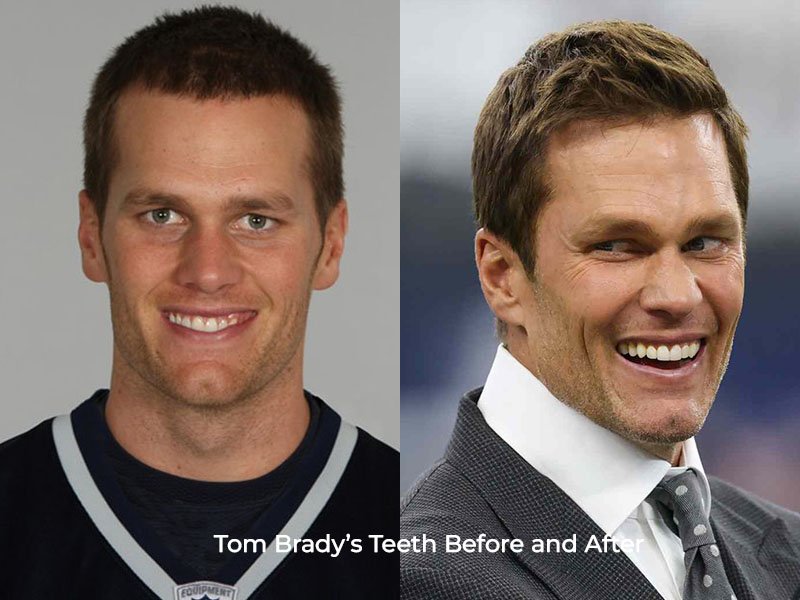 Tom Brady Teeth Before and After