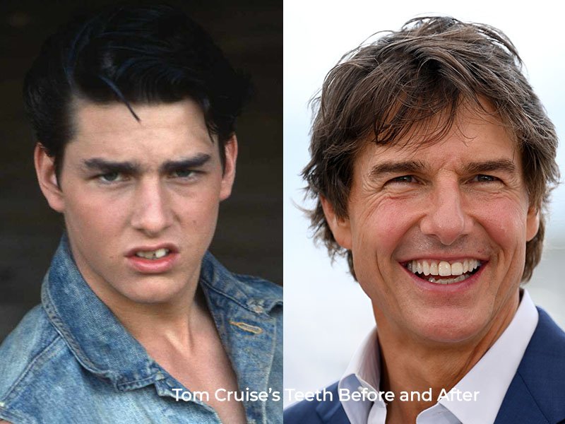 Tom Cruise Teeth Before and After