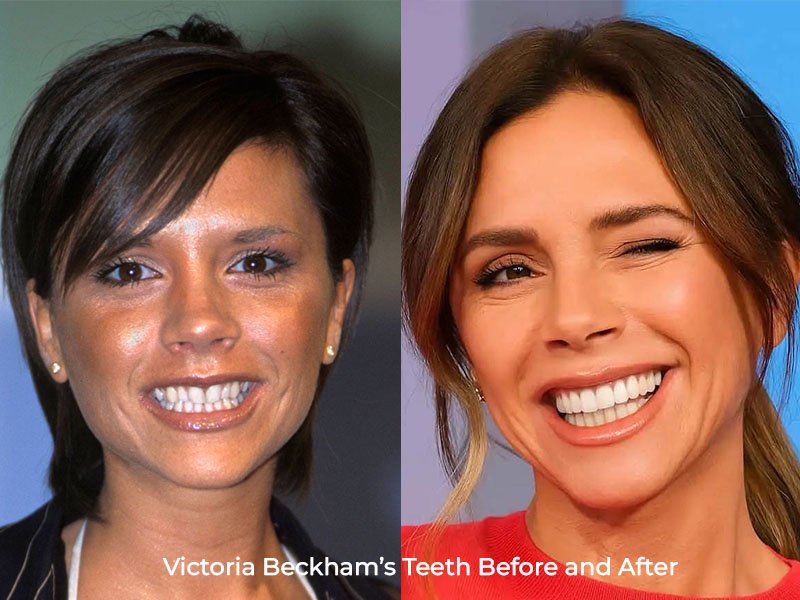 Victoria Beckham Teeth Before and After