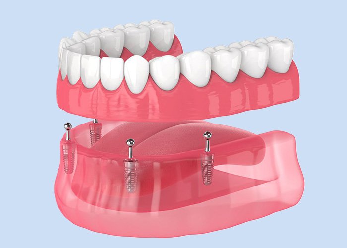 Mini Dental Implants: Benefits, Procedure, Cost and Recovery What Are Mini Dental Implants