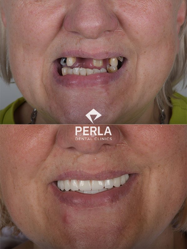 before and after Full Mouth Reconstruction Antalya Turkey Perla Dental