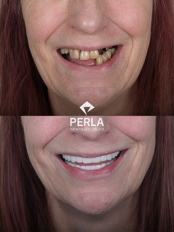 before and after Full Mouth Reconstruction Turkey Antalya Perla Dental
