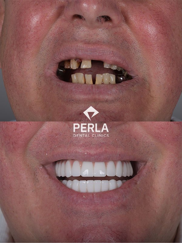 before and after Full Mouth Reconstruction Turkey Antalya