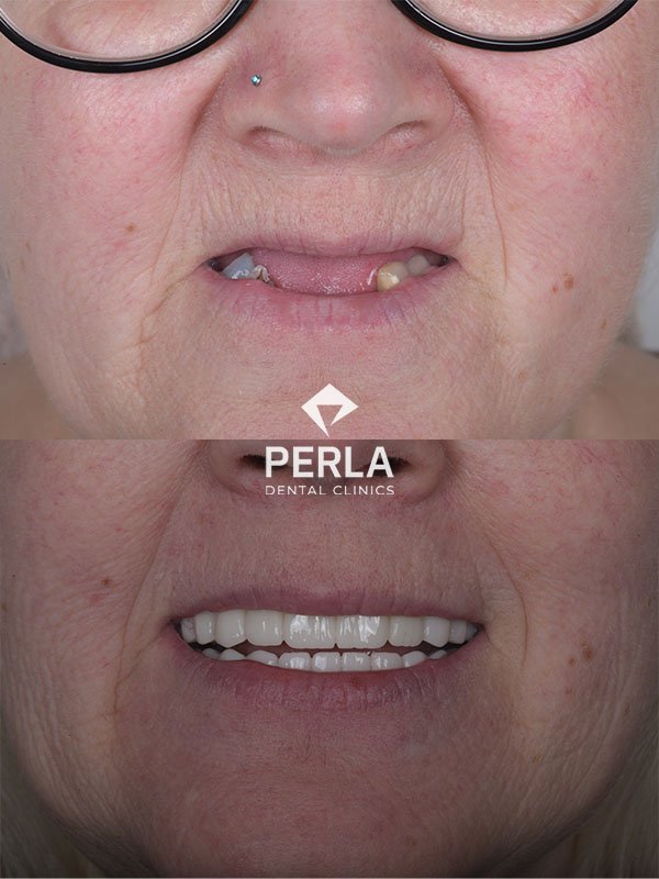 before and after Full Mouth Reconstruction Turkey