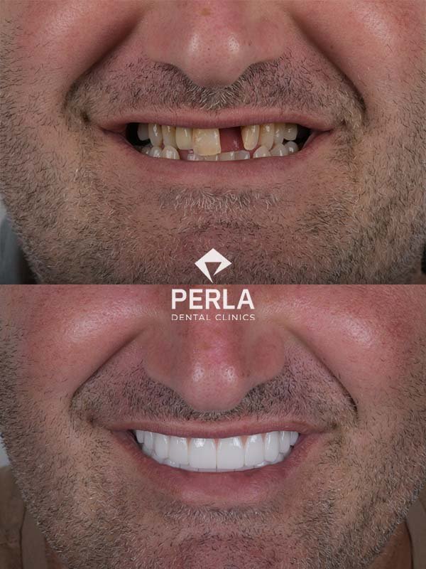 before and after Full Mouth Reconstruction