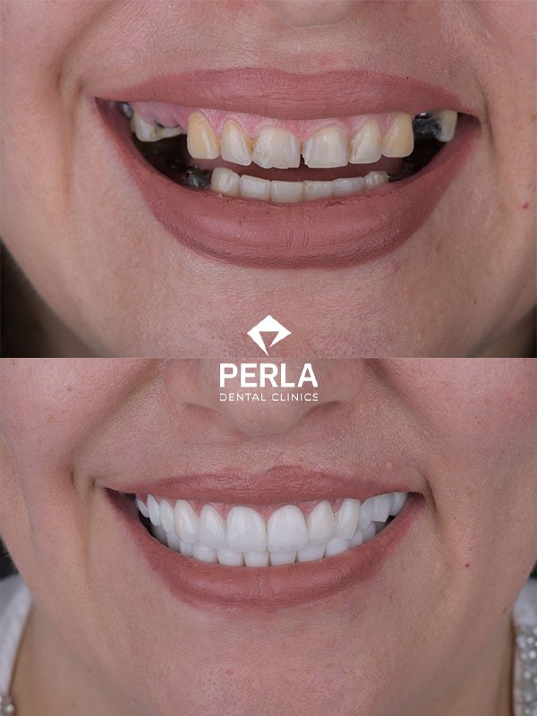 All on 4 Implants in Turkey Before After Results​ Perla Dental Antalya