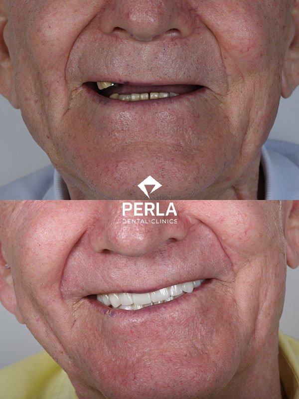 All on 4 Implants in Turkey Before After Results​ Perla Dental Clinics Antalya