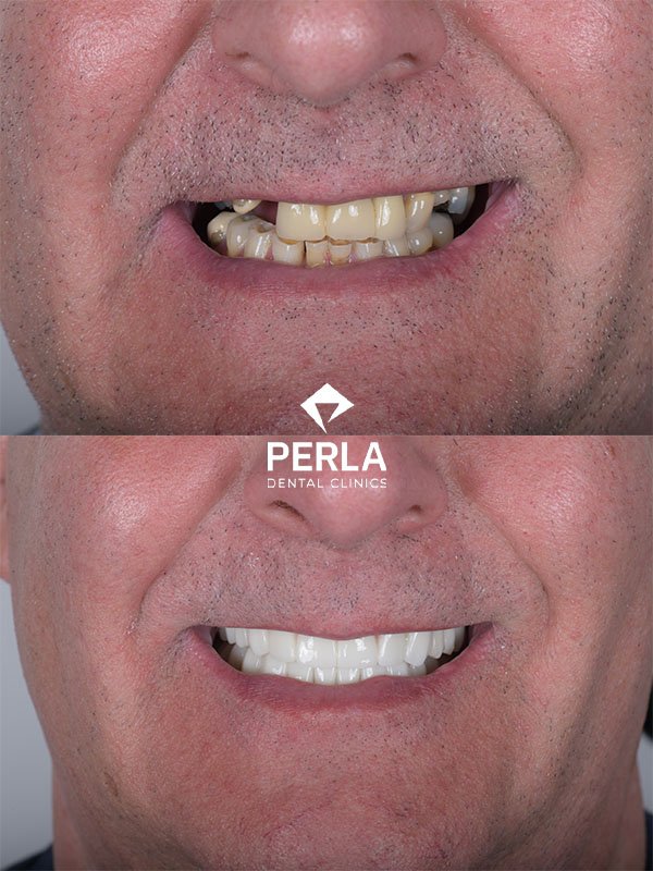 All on 4 Implants in Turkey Before After Results​ Perla Dental