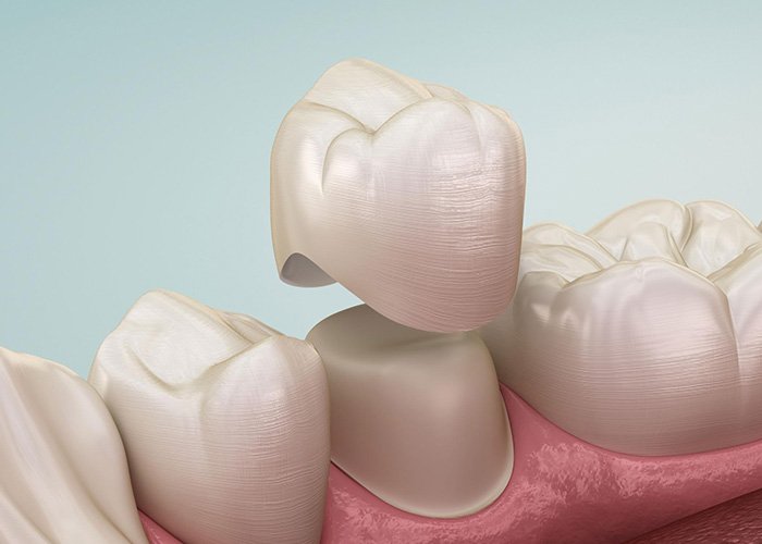 Dental Crown For full coverage support