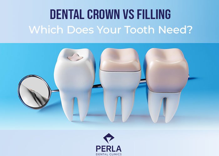 Dental Crown vs Filling Which Does Your Tooth Need