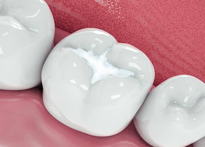 Dental Filling For localised support