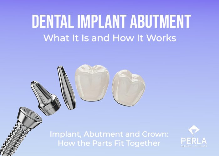 Dental Implant Abutment: What It Is and How It Works Dental Implant Abutment What It Is and How It Works