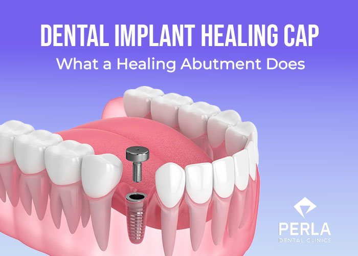Dental Implants in Turkey: Prices, Packages and Procedures Dental Implant Healing Cap What a Healing Abutment Does