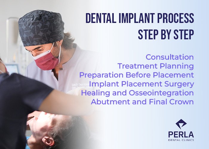 Dental Implant Process Step by Step