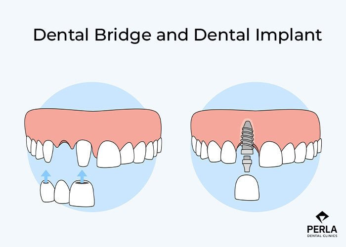 Dental Implant vs Bridge: Which Tooth Replacement Is Right for You? Difference Between a Dental Implant and a Dental Bridge