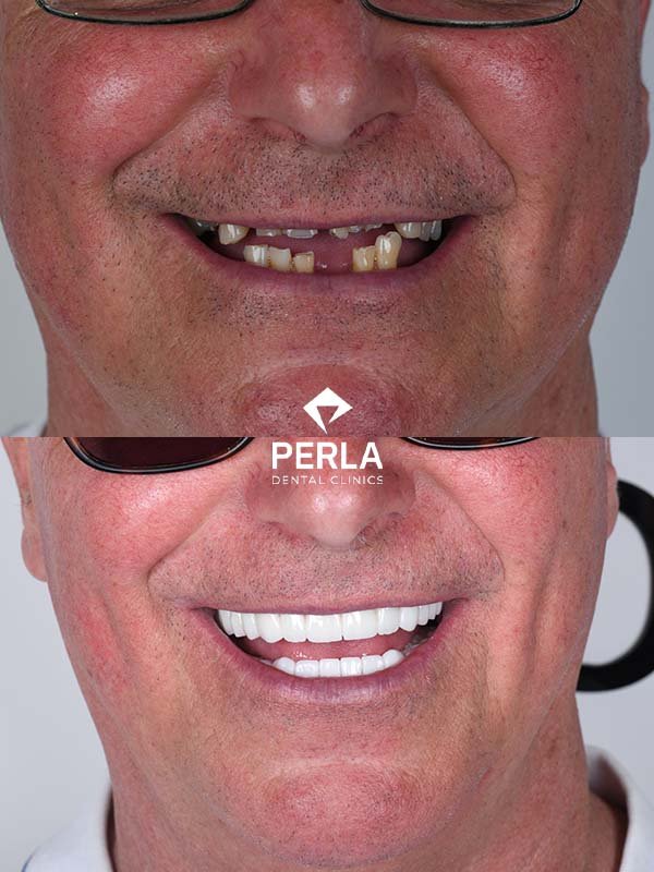 Full mouth dental implants in Turkey Before After Results​ Perla Dental Antalya