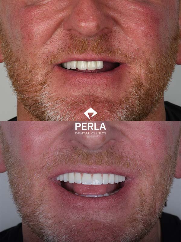 Full mouth dental implants in Turkey Before After Results​ Perla Dental Clinics Antalya