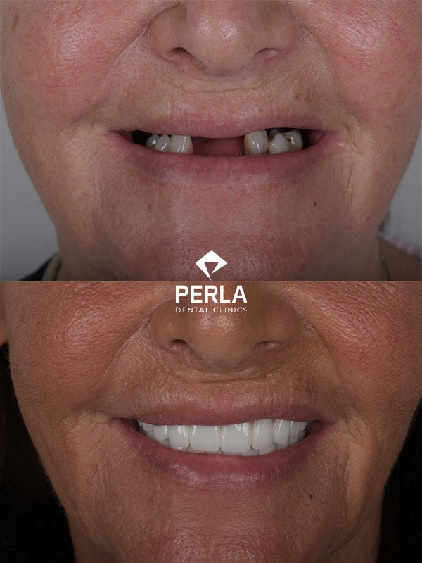 Full mouth dental implants in Turkey Before After​