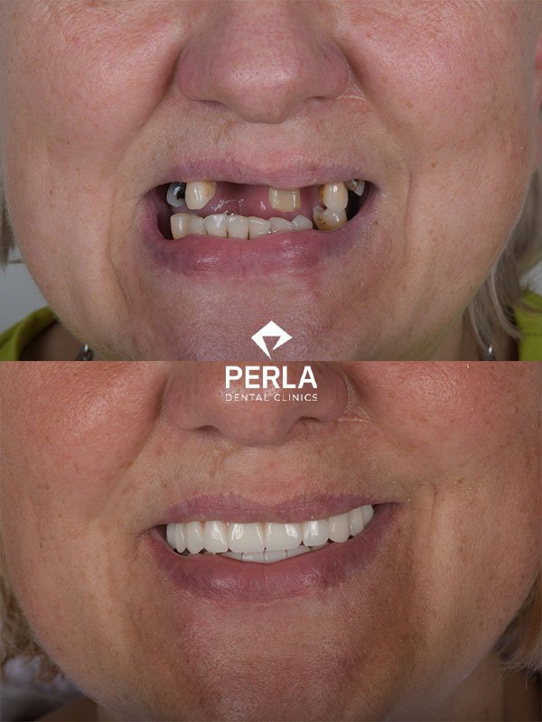 Full mouth dental implantsTurkey Before After Results​ Perla Dental