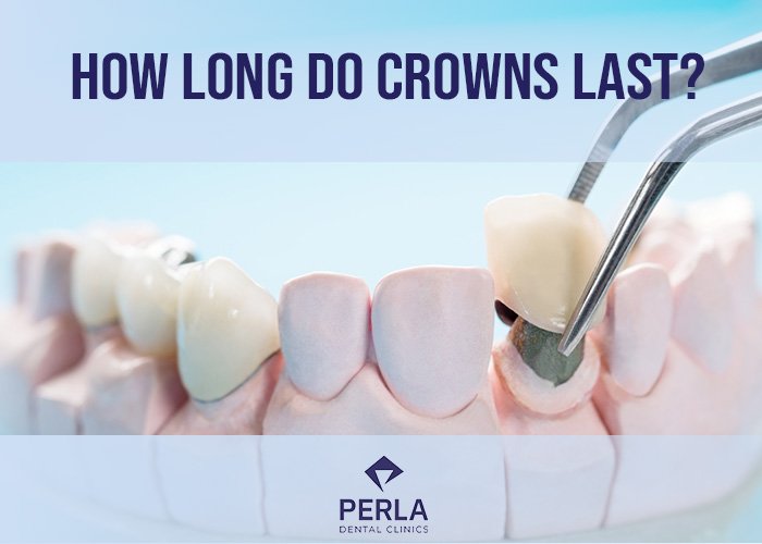 How Long Do Crowns Last? How Long Do Crowns Last