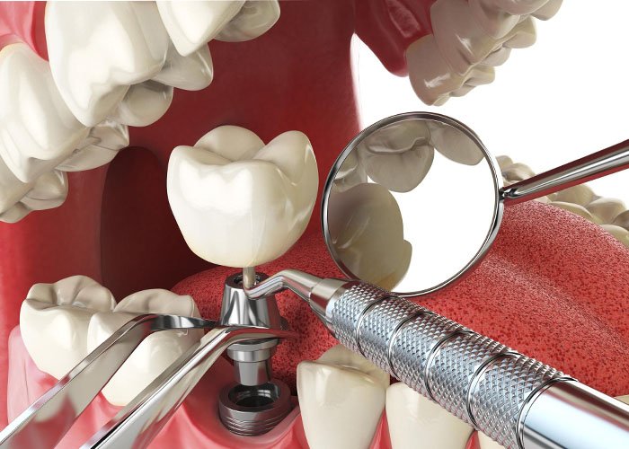 Molar Tooth Implant: Should You Replace a Missing Back Tooth? Molar Implant Suitability, Jawbone, Gum Health and Long-Missing Teeth