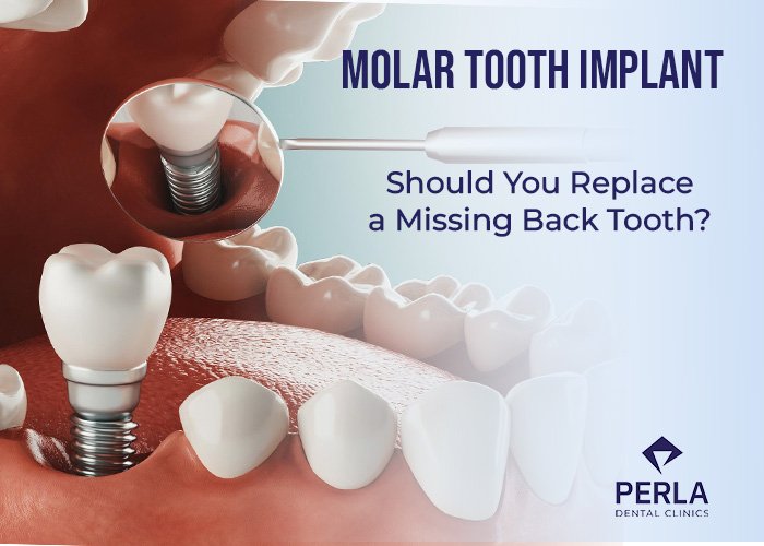 Molar Tooth Implant: Should You Replace a Missing Back Tooth? Molar Tooth Implant Should You Replace a Missing Back Tooth