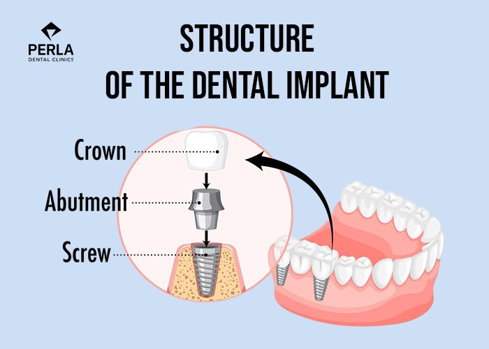 Dental Implant Abutment: What It Is and How It Works structure of the dental implant