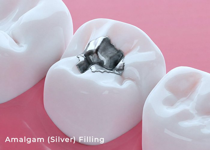 Amalgam fillings are made of an alloy called an amalgam