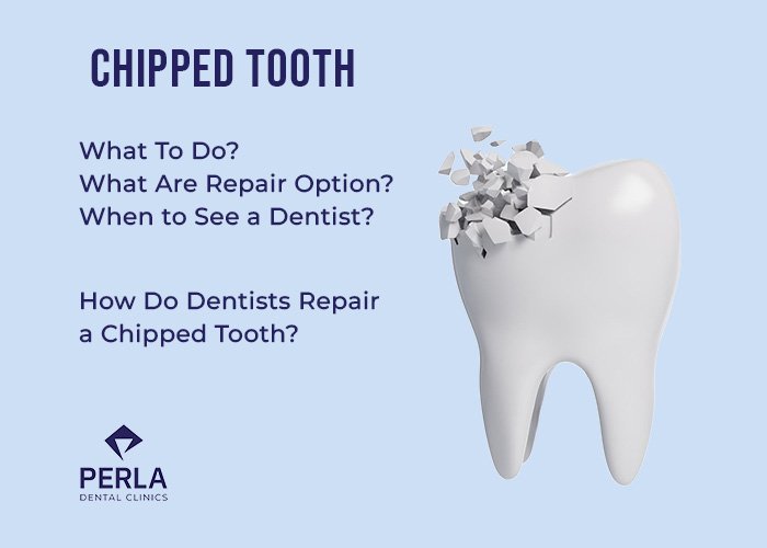 Chipped Tooth: What To Do, Repair Options and When to See a Dentist Chipped Tooth What To Do, Repair Options, When to See a Dentist