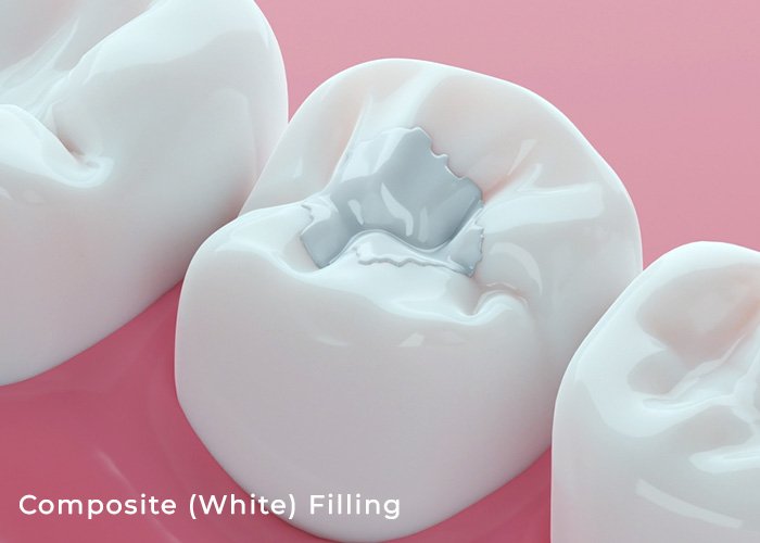 Composite fillings are restorations used to repair decayed teeth