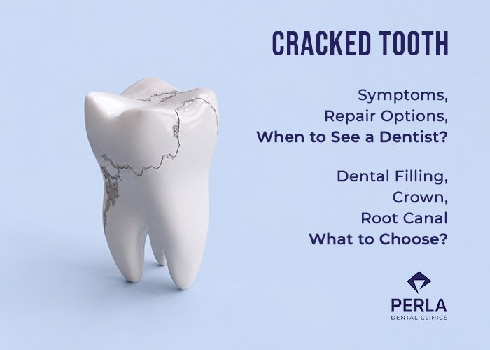 Cracked Tooth: Symptoms, Repair Options and When to See a Dentist Cracked Tooth Symptoms, Repair Options and When to See a Dentist