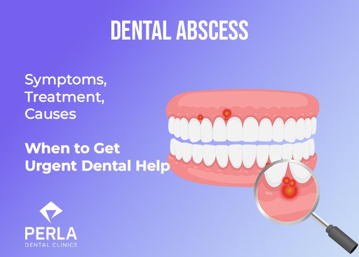 Dental Holiday in Antalya, Turkey: Prices & Packages for Dental Tourism Dental Abscess Symptoms, Treatment and When to Get Urgent Dental Help