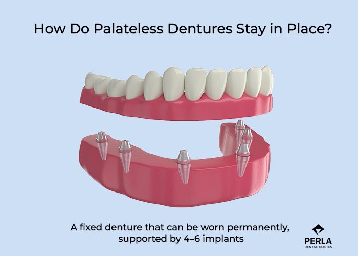 Palateless Dentures How Do Palateless Dentures Stay in Placejpg