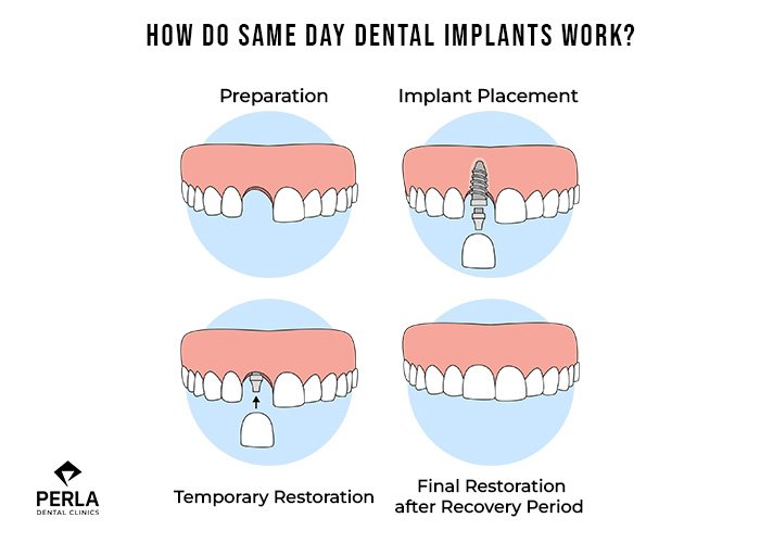 How Do Same Day Dental Implants Work