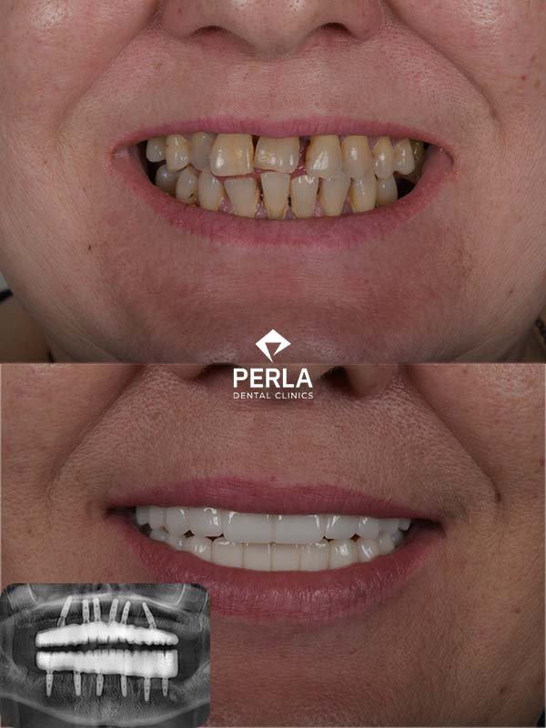 Multiple Dental Implants in Turkey Multiple Dental Implants Turkey before after Perla Dental