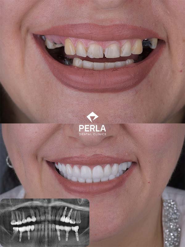 Multiple Dental Implants in Turkey Multiple Dental Implants Turkey before after