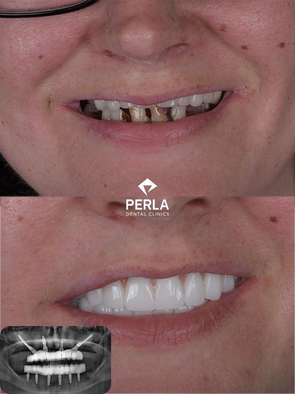 Multiple Dental Implants in Turkey Multiple Dental Implants in Turkey before after Perla Dental