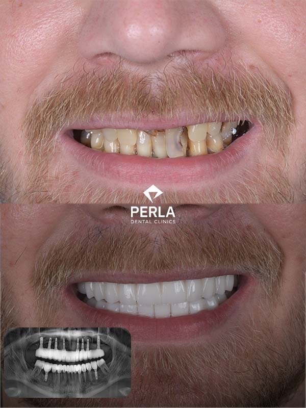 Multiple Dental Implants in Turkey Multiple Dental Implants in Turkey before after