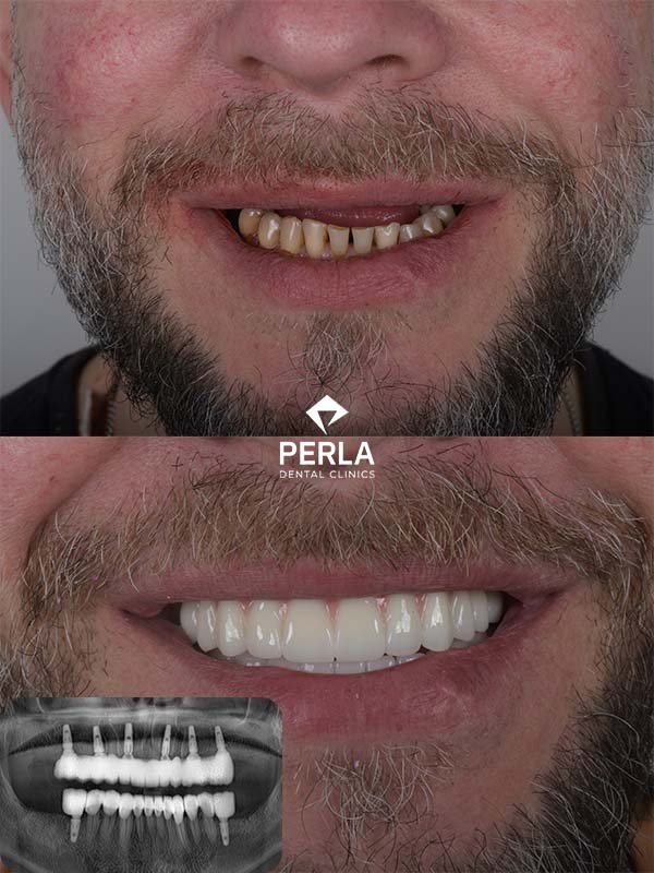 Multiple Dental Implants in Turkey Multiple Dental Implants in Turkey before and after