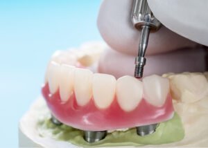 Palateless Dentures Palateless dentures require implants or clasps for support