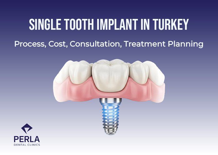 Single Tooth Implant in Turkey Single tooth implant Process, Cost, Consultation, Treatment Planning