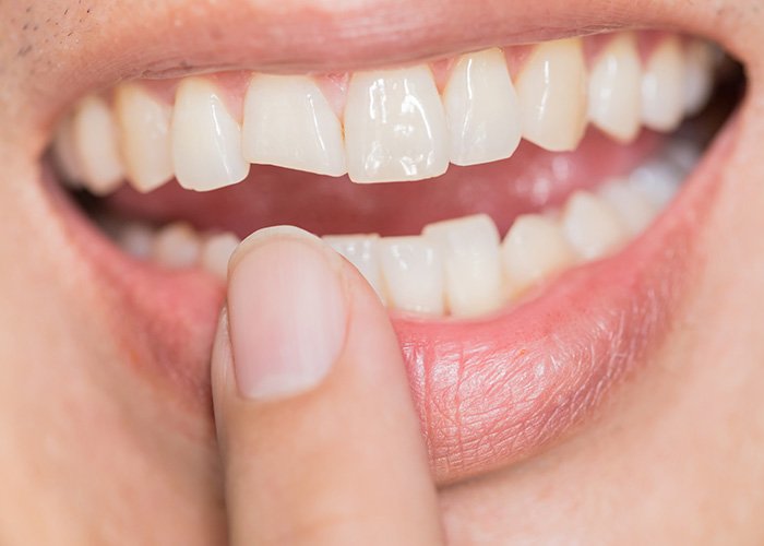 Teeth may chip due to many reasons
